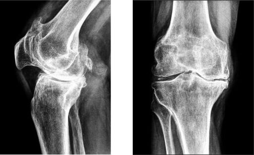 Gonartrose da articulación do xeonllo na radiografía