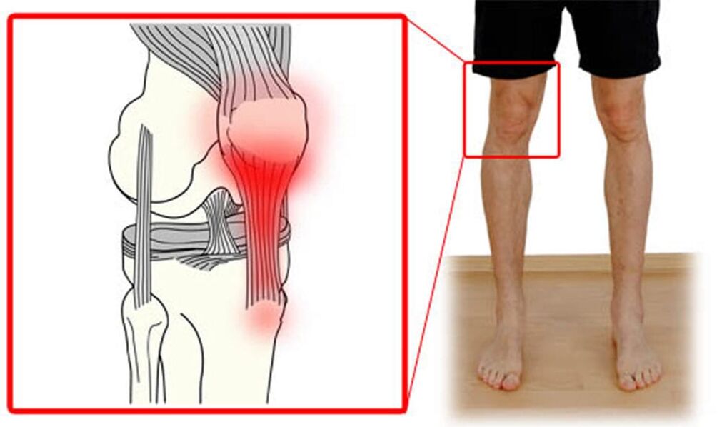 Tendinite - Inflamación dos tendóns da articulación do xeonllo