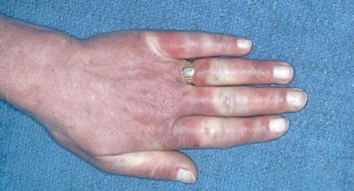 Cadro clínico da síndrome de Raynaud - vasoespasmo, hiperemia, edema