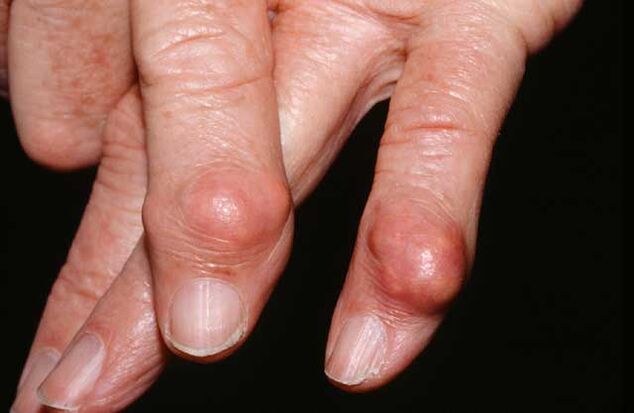O engrosamento do tecido subcutáneo (tophi) é un sinal de gota.