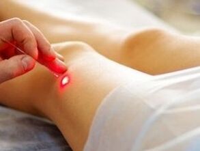 Tratamento da artrose da articulación do xeonllo cun láser